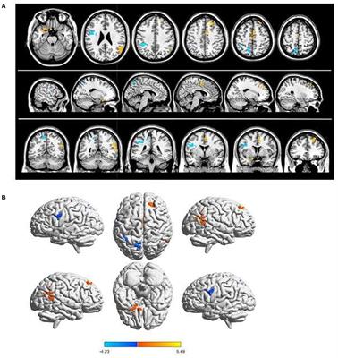 Children with strabismus and amblyopia presented abnormal spontaneous brain activities measured through fractional amplitude of low-frequency fluctuation (fALFF)